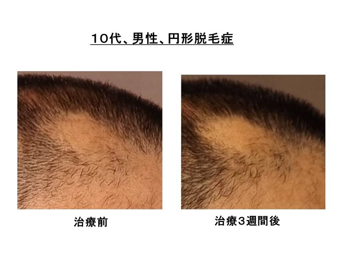 円形脱毛症　病院""